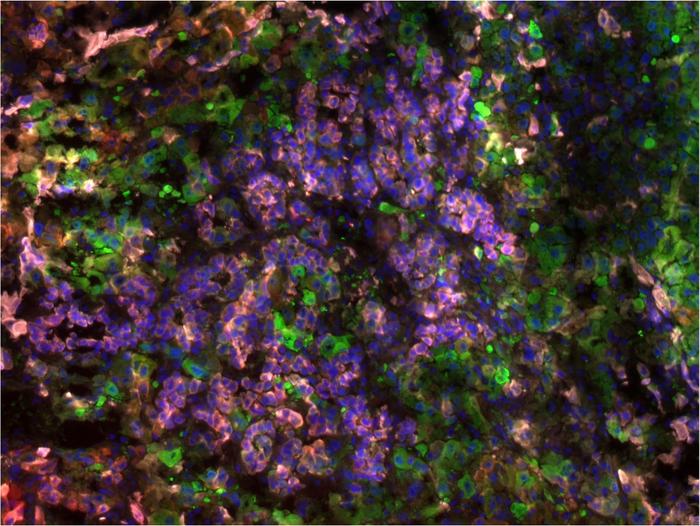 MYCN drives tumorigenesis in liver cancer