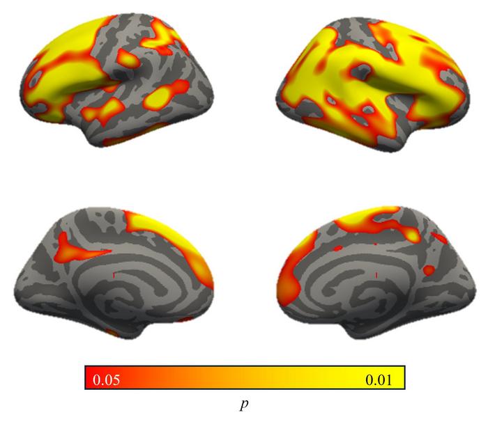 Reduced Gray-White Contrast in Chronic Post-Traumatic Stress Disorder in World Trade Center Responders