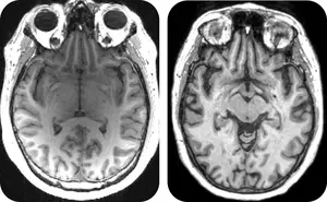 Two MRI brain scans of patients at early stages of dementia.