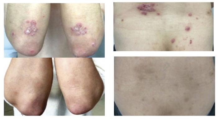 Pantethine supplementation helps alleviate psoriasis symptoms