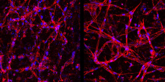 Diseased Retinal Cells