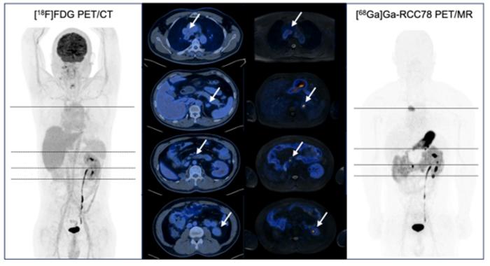 A 68Ga-RCC78 PET scan of a patient four years post-radical right nephrectomy.