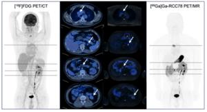 A 68Ga-RCC78 PET scan of a patient four years post-radical right nephrectomy.