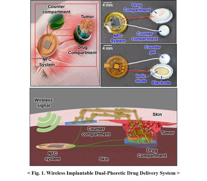 Figure 1. Wireless Implantable Dual-Phoretic Drug Delivery Sysytem