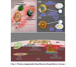 Figure 1. Wireless Implantable Dual-Phoretic Drug Delivery Sysytem