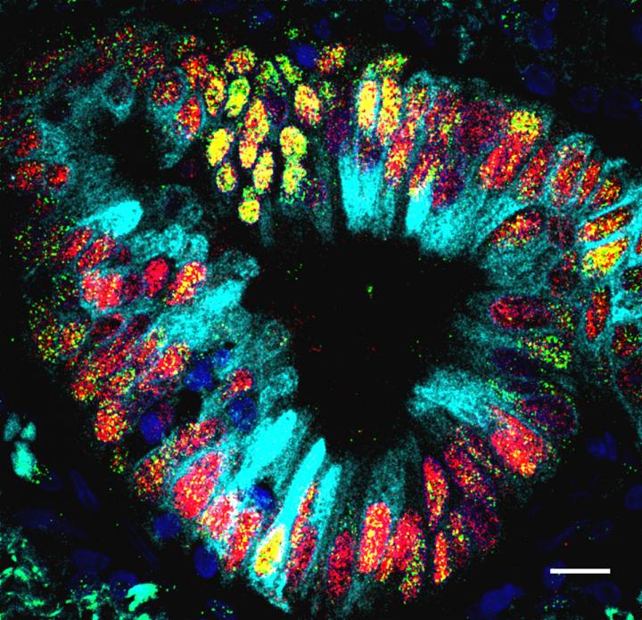 Stomach Cells in Lung Tumor