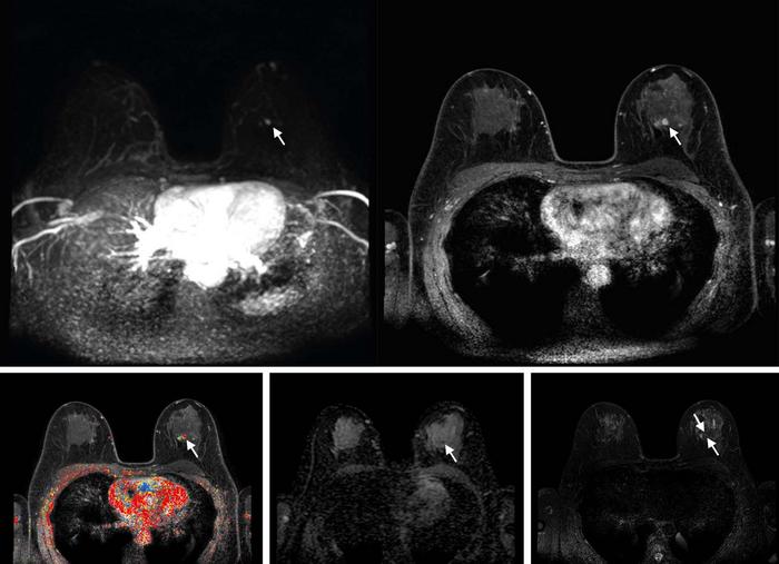 Abbreviated breast MRI images
