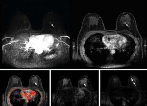 Abbreviated breast MRI images