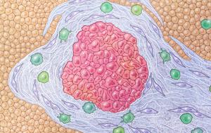 Pancreatic cancer illustration