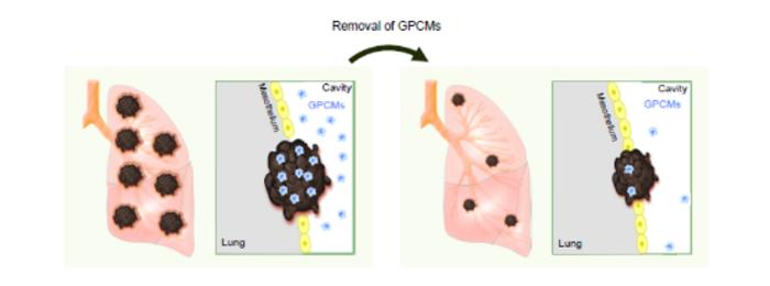 Pleural cavity macrophages infiltrate lung tumors and promote progression. Their depletion or Gata6 deletion suppresses tumors and enhances immunity