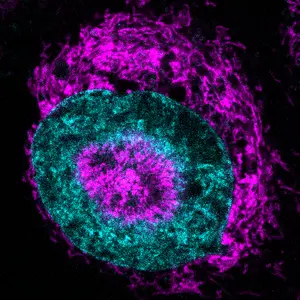Confined cancer cells