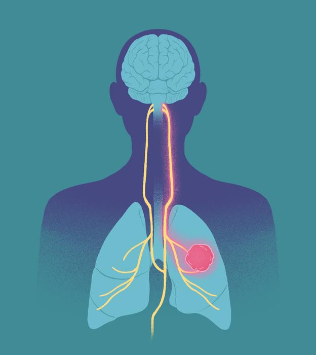 Lung cancer to brain superhighway illustration
