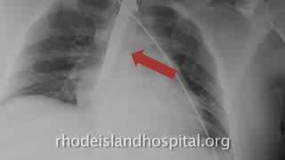 Steven Moss, M.D., Discusses Intentionally Swallowed Foreign Bodies and the Cost