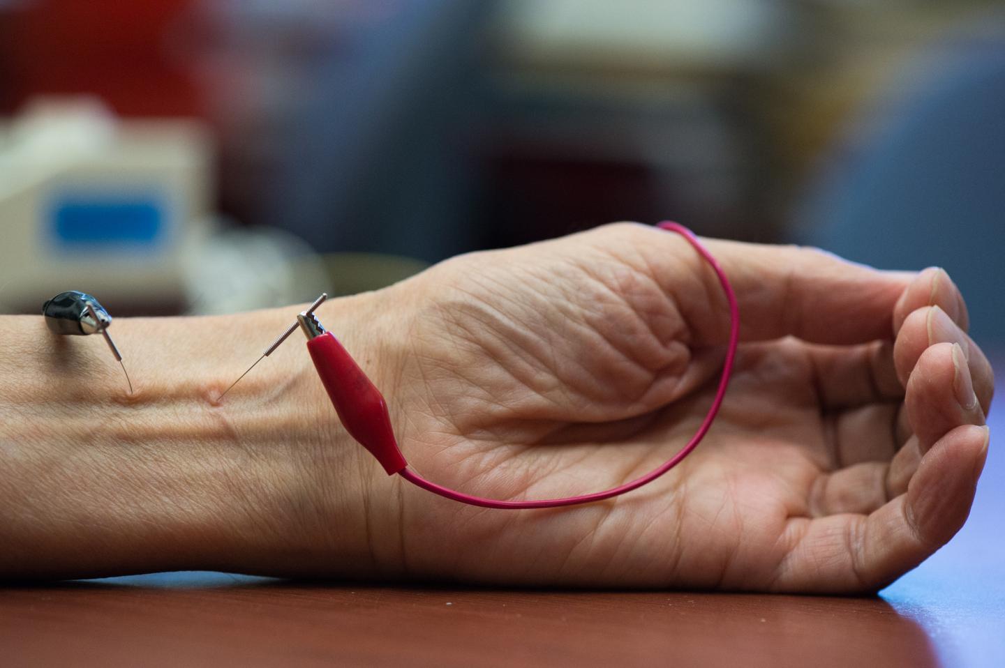 Electroacpuncture