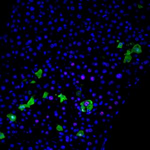 A section of a mouse liver in which RAS-positive senescent premalignant cells are marked in green, and the expression of a splicing factor (SF3B4) in red. Splicing factor expression is higher in and more frequent in RAS-positive cells.