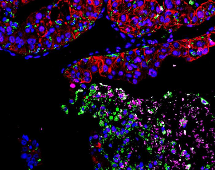 Cancer cells commandeer iron-recycling cells, causing anemia