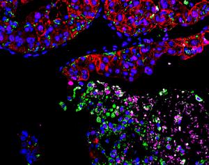Cancer cells commandeer iron-recycling cells, causing anemia
