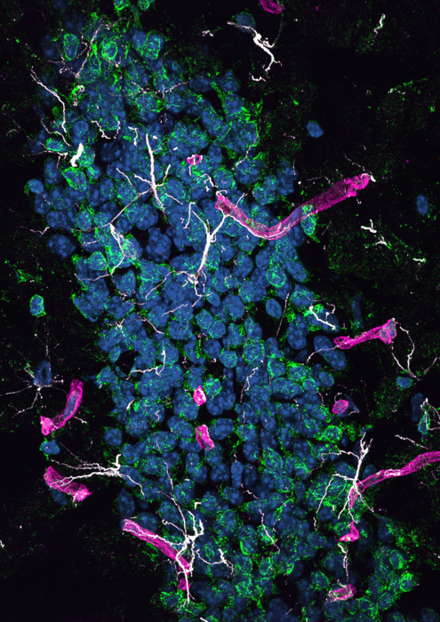Protein from the liver may cause Alzheimer’s disease in the brain
