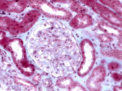 Biopsy of Renal Graft