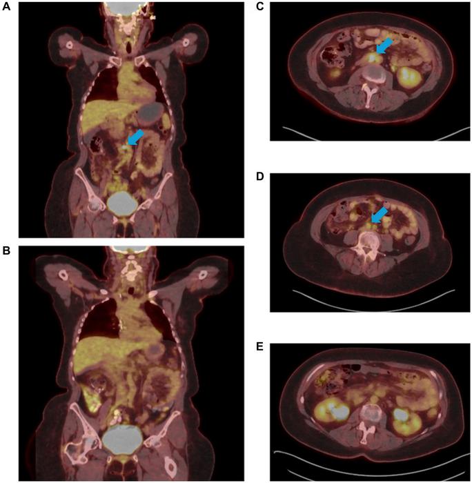 WIN-MTB-2024002 – WIN International Molecular Tumor Board: A 52-year-old female with unmeasurable Stage IIIc colon cancer