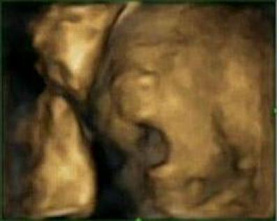 Yawn at 27.5 Weeks