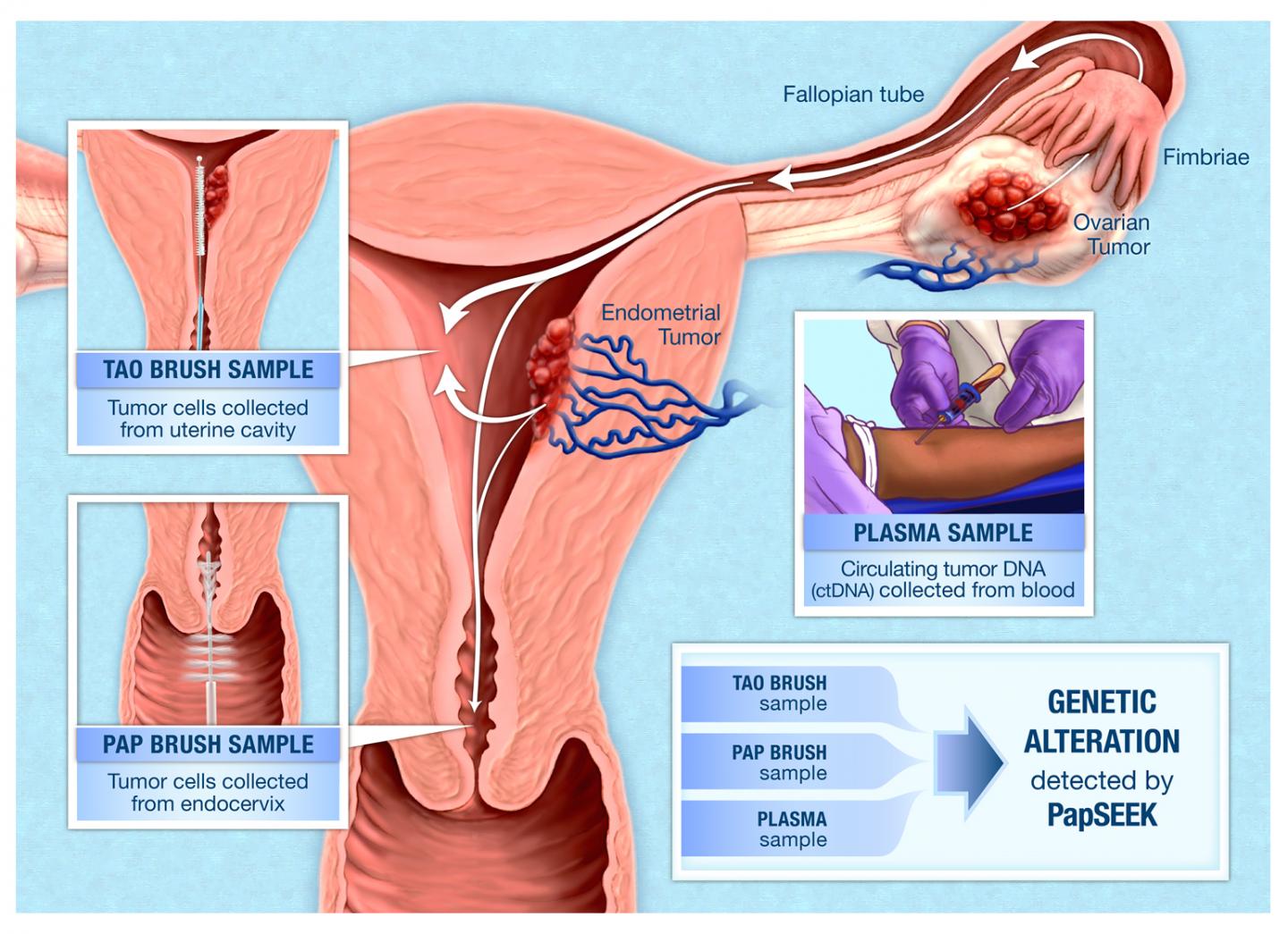 Detecting Ovarian and Endometrial Cancer with Routine Pap Tests