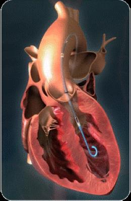Artificial Heart