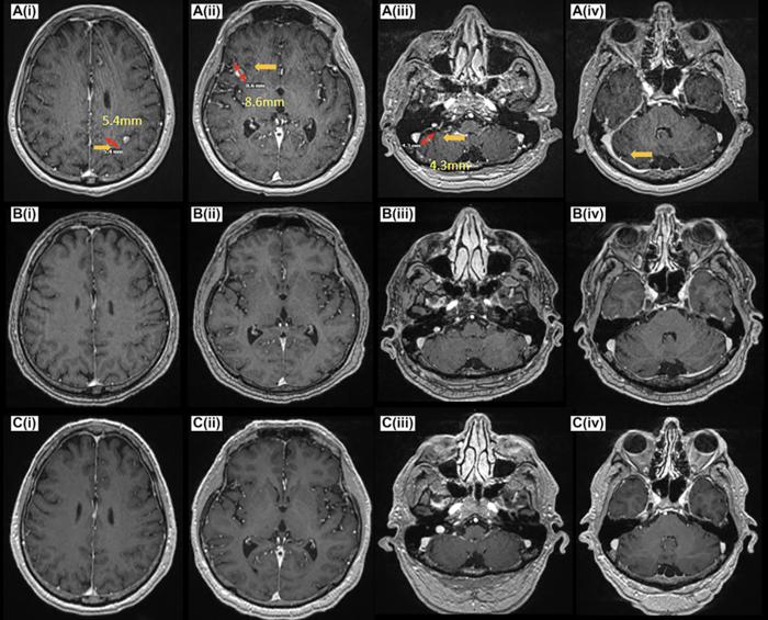 Durable complete response in leptomeningeal disease of EGFR mutated non-small cell lung cancer to amivantamab, an EGFR-MET receptor bispecific antibody, after progressing on osimertinib