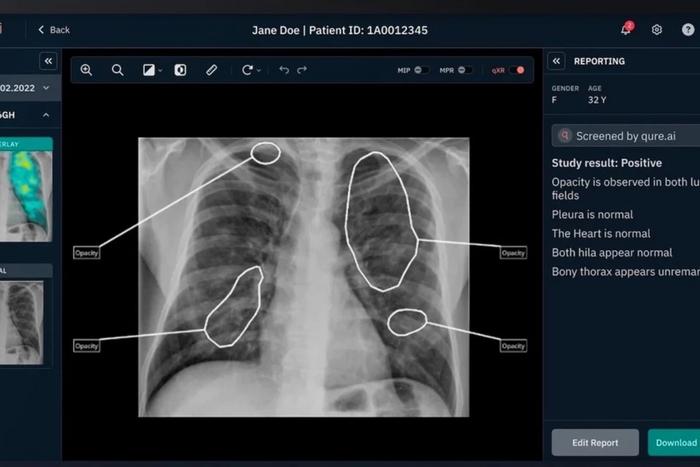Putting AI to bear on the public health gap in the Philippines