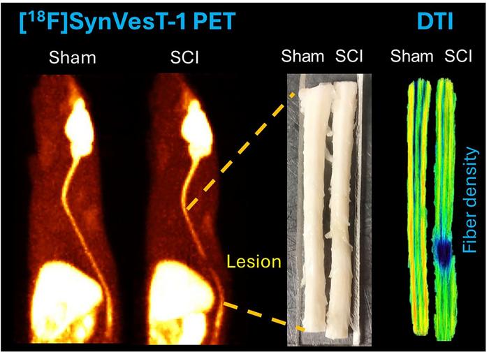 [18F]SynVesT-1 PET imaging reveals synapse loss at the spinal cord injury epicenter and in related brain regions.