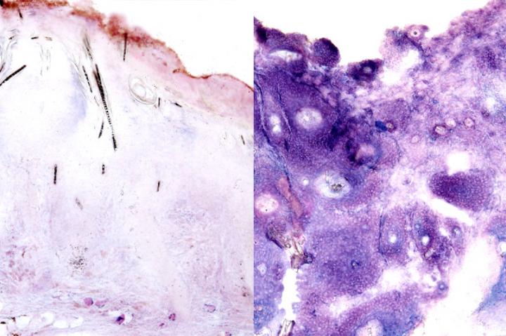 Tumor Comparison