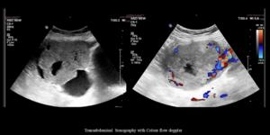 A rare case of pure non-gestational ovarian choriocarcinoma: Diagnostic mimicry and management strategies