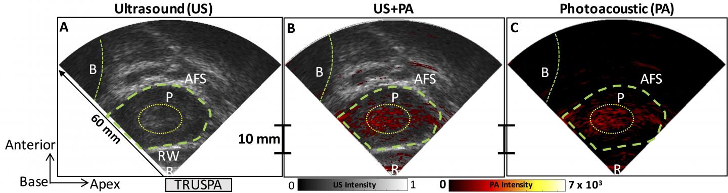 A Dual Imaging Approach May Improve Diagnosis and Monitoring of Prostate Cancer (1 of 2)
