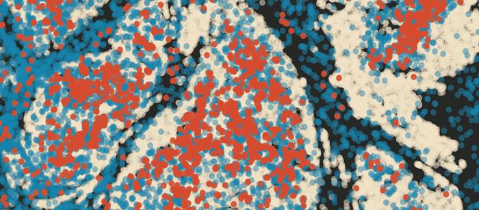 Tumour containing infiltrating neutrophils