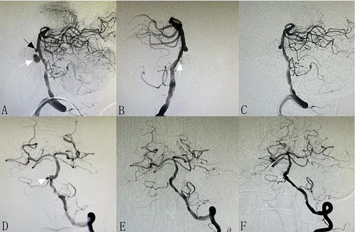 Basilar Trunk Artery Aneurysms and Modern Treatment Approaches