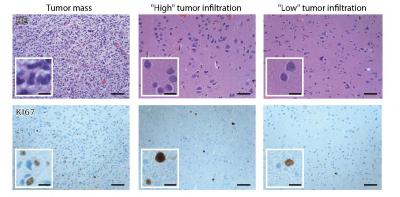 Chloride Imbalance May Explain Tumor-Linked Seizures (1 of 1)