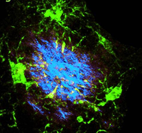 Cleanup of Alzheimer's Plaques Slowed