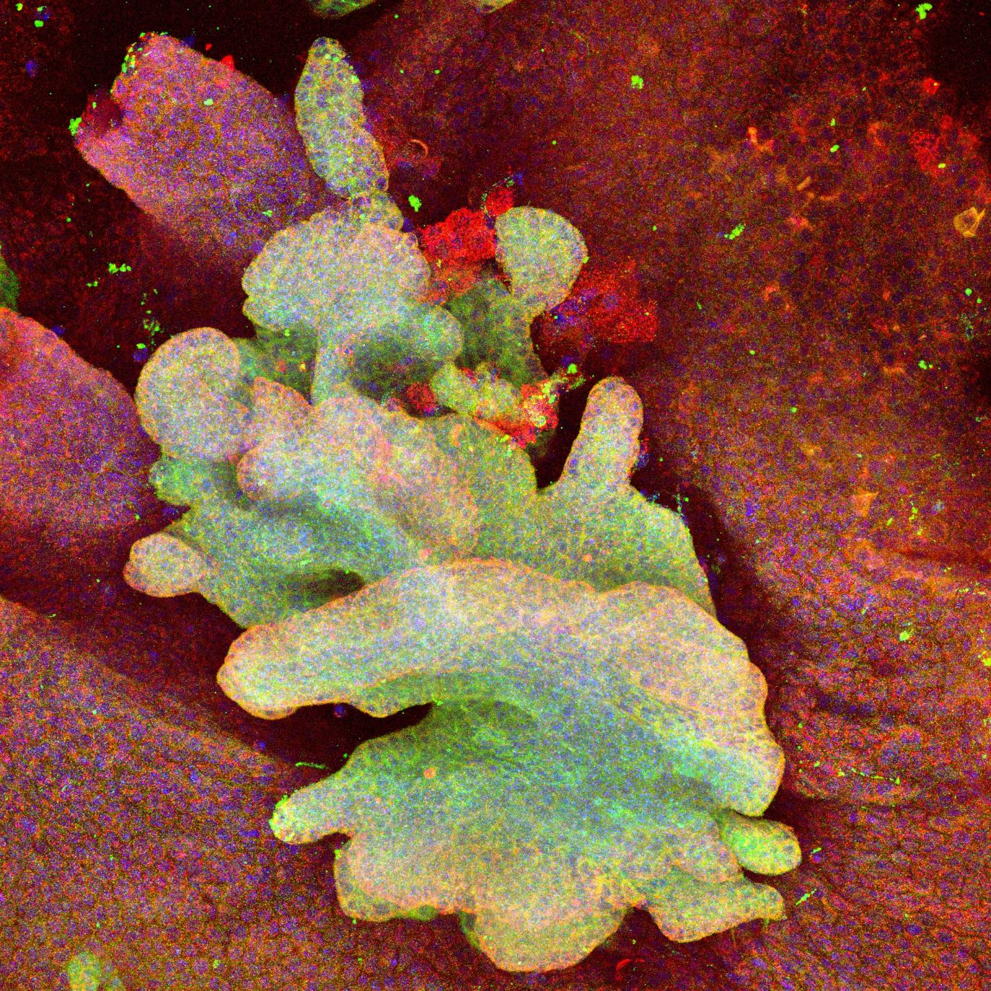 Basal Cell Carcinoma