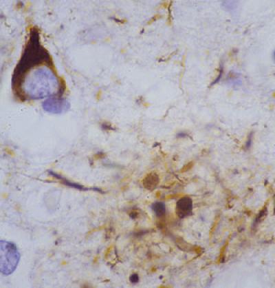 Tangle and Plaque in Alzheimer's Brain