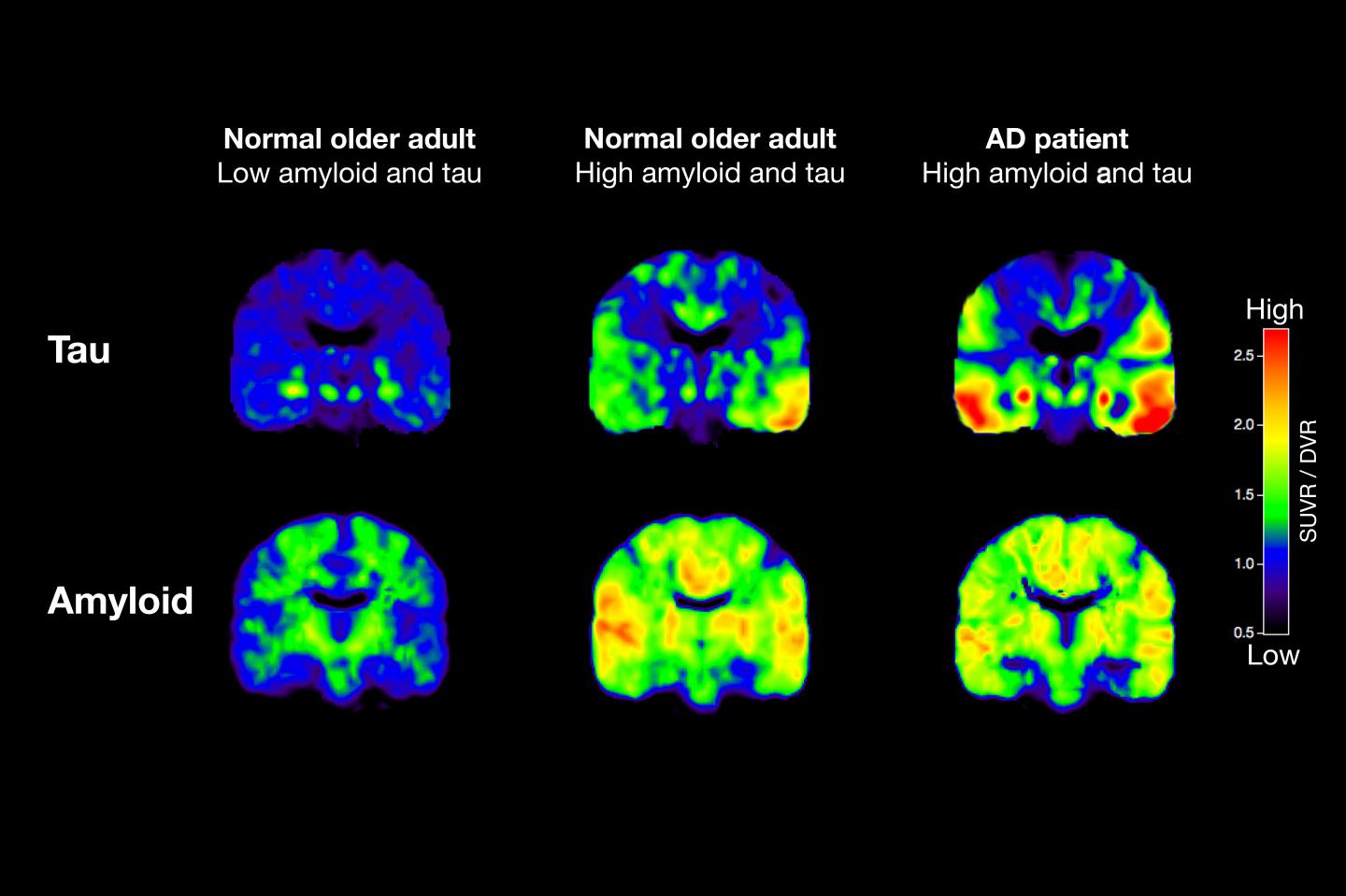 PET Scans