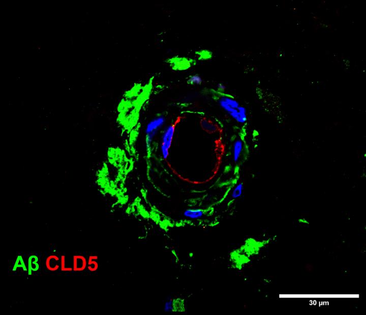 Amyloid-beta and Claudin-5 eurekalert