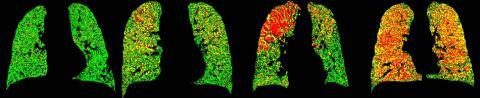 Lung Imaging of COPD