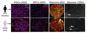 Huntington's disease
