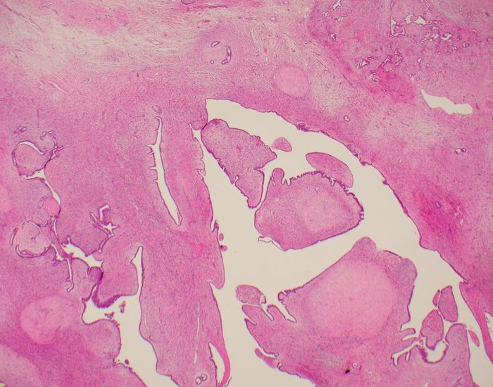 Phyllodes tumour