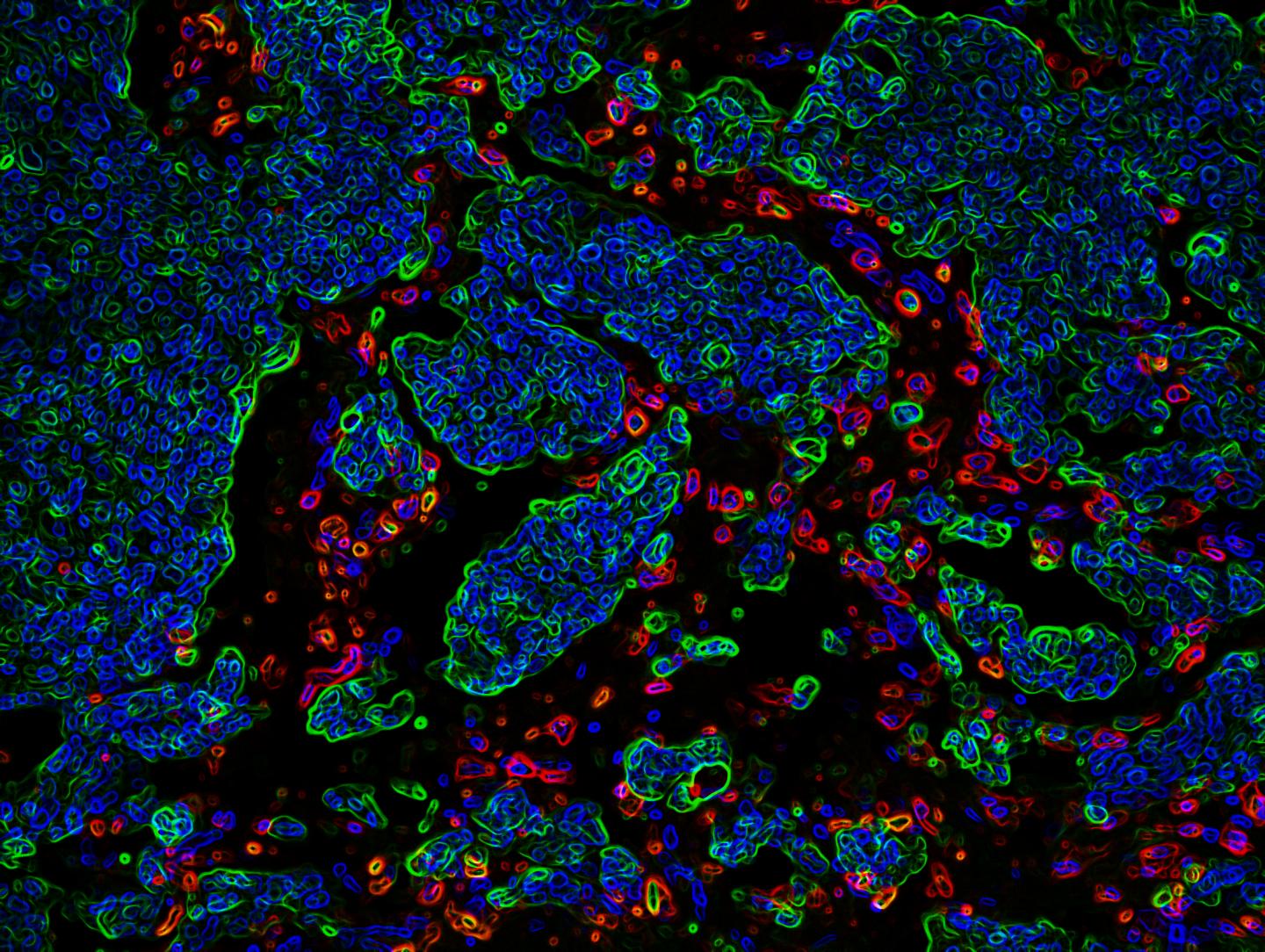 Tumor Cells