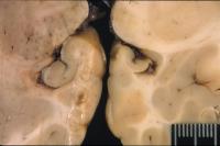 Domoic Acid Brain Damage
