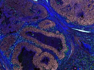 Imaging of human melanoma biopsy