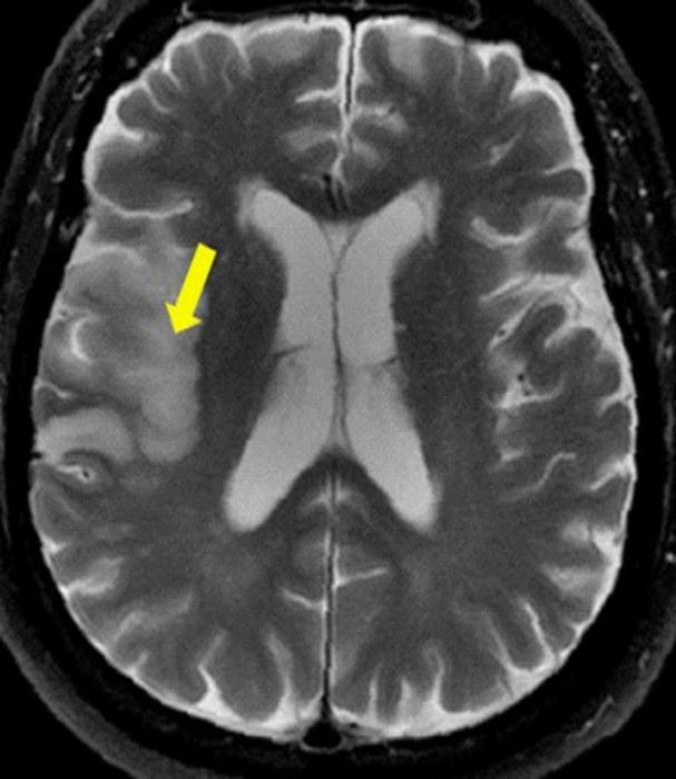 Magnetic resonance imaging showing cerebral infarction.