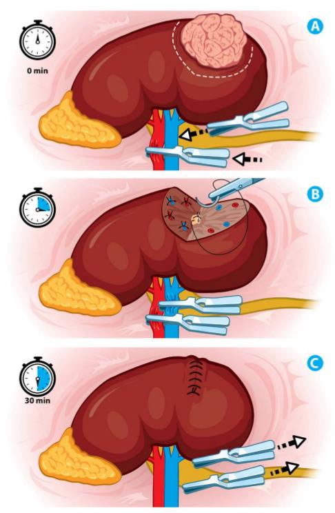 Ischemia Techniques