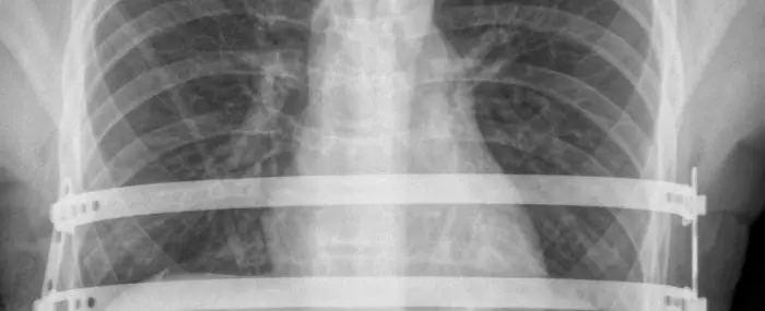 Prosthetic device developed in Brazil improves results of chest malformation repair surgery